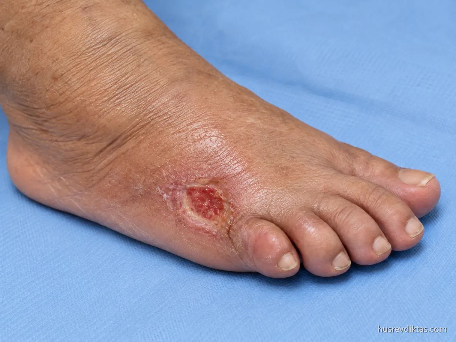 Antibiyotik bittikten sonra yaklaşık 1,2 cm'ye küçülmüş, sağlıklı kırmızı granülasyon dokusuyla dolu ve çevresinde kızarıklık olmayan ayak yarası